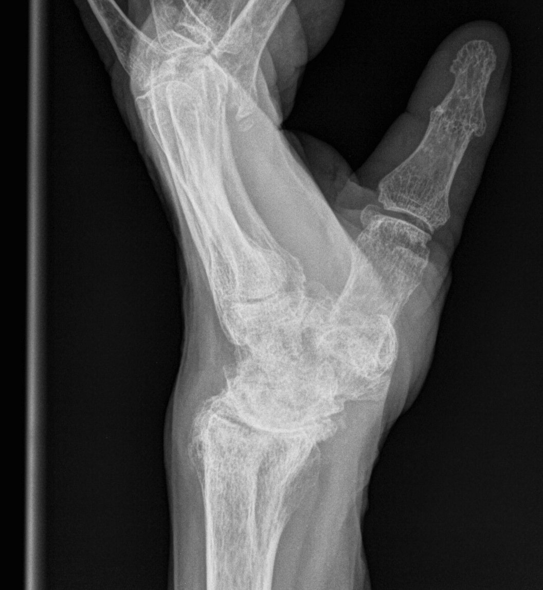 Rheumatoid Wrist Carpal Collapse